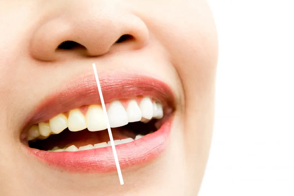 Get a brighter smile with professional teeth whitening in Albania at Luce Dent Clinic. Safe, effective, and affordable cosmetic dental treatments.