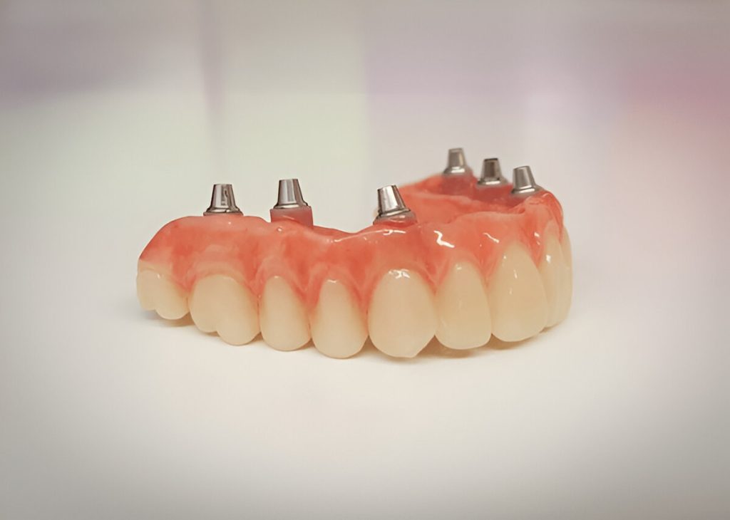 Restore your full smile with All On 6 Dental Implants. A stable, long-lasting solution for missing teeth with expert care.