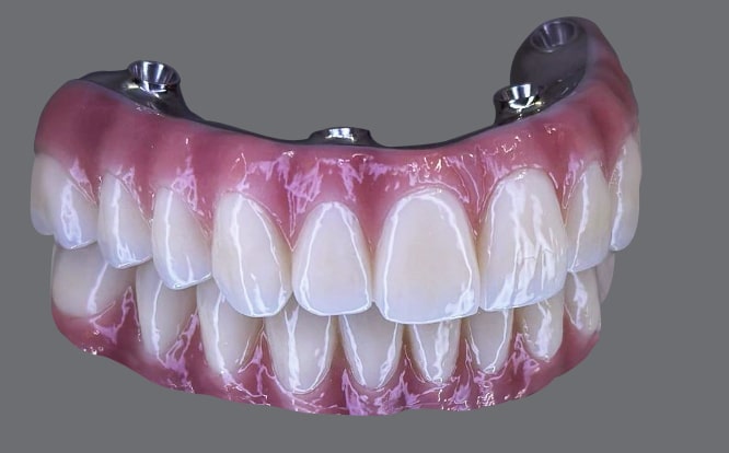 Discover the top benefits of All on 4 dental implants for a natural, durable, and affordable full-arch tooth replacement. Learn why Luce Dent in Albania is your best choice.