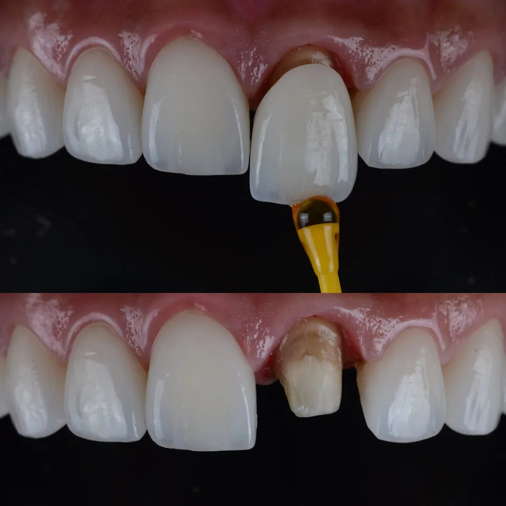 Dental Crowns in albania