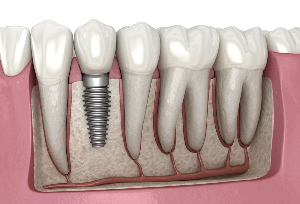 In this detailed guide, we explore the dental implant price in Albania, what influences the cost, what’s typically included in treatment