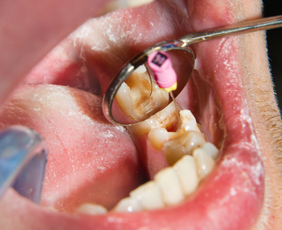 Experience expert endodontics in Albania at Luce Dent Clinic. We offer painless root canal treatments using advanced technology.